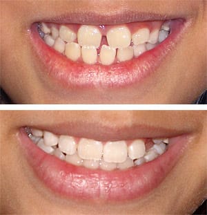 Teeth, before and after braces